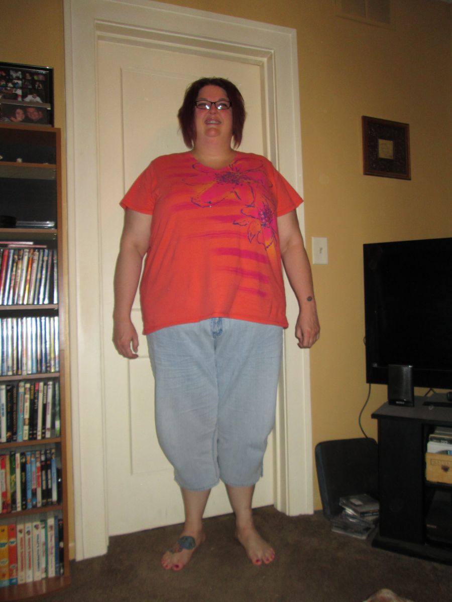 Pre Surgery Pics