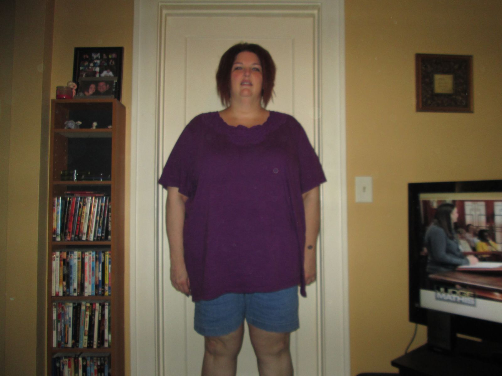 One Month Post Op Pics 7/11/2013