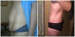 before after side