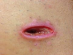 2.5 weeks out and still open incision