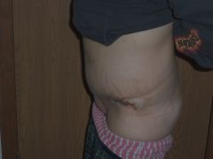 5 days post Op