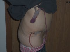 5 days post Op (3)