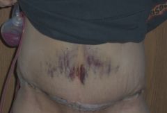 5 days post Op (2)
