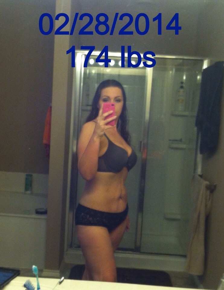 Gastric Sleeve