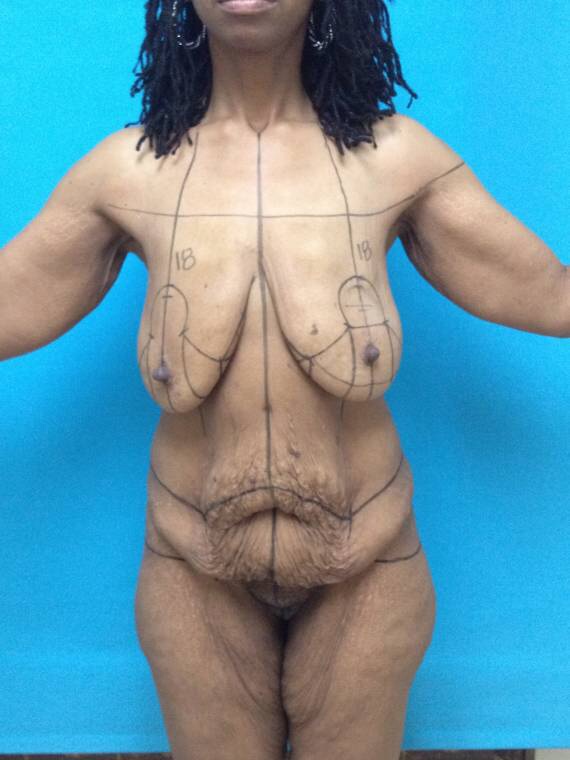 Before plastic surgery. Post weight loss