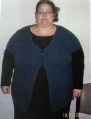 BEFORE pic taken at surgeons office