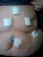 My tummy day after surgery 2.14.09...yes...I like Kermit :)