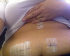 3 days after surgery