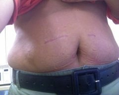 scars around 2 months