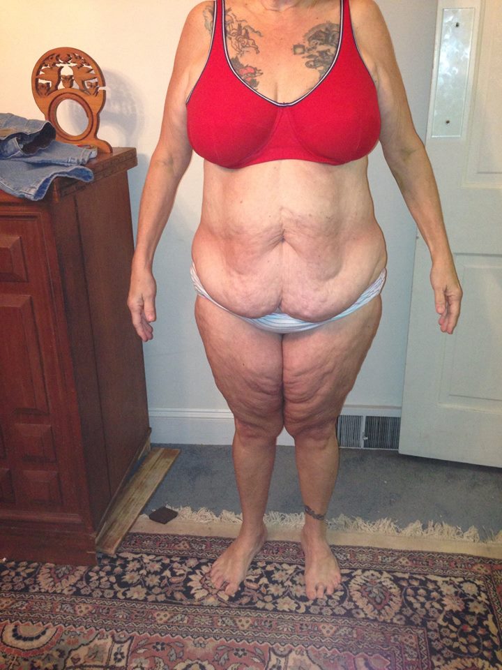 Before lower body lift