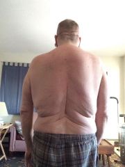 after surgery 2014