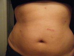 My scars!!