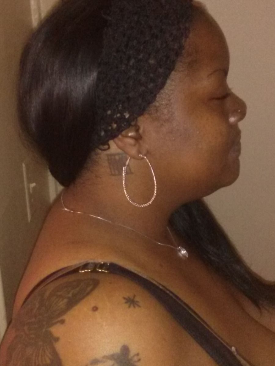 April:  One week before surgery @ 270 lbs