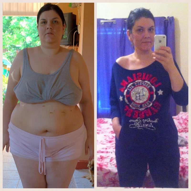 Before and 10 months post op