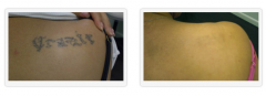 Remove Body Tattoos