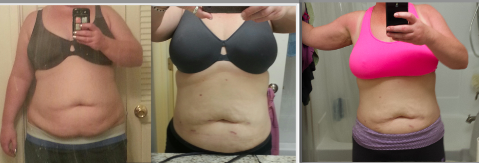 6 Months Post VSG Progress