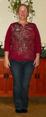 4 Months post-op