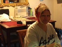 facelift day 1. Just got home from having surgery.