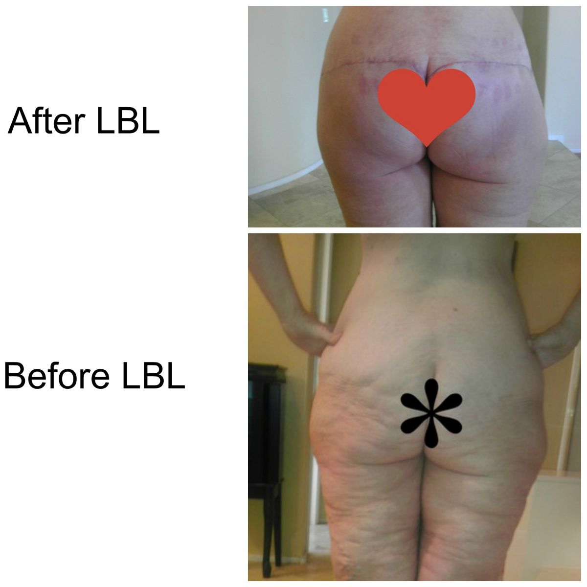 Lower Body Lift