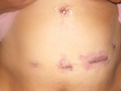 day after surgery