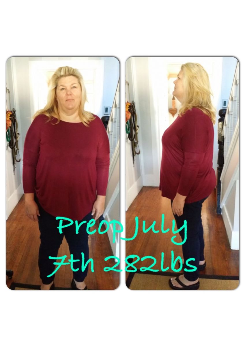 Gastric Sleeve Preop