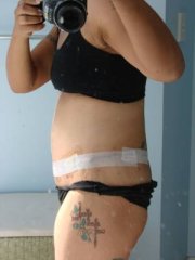 10 days post side