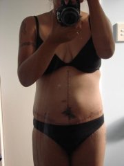 3 weeks postop front