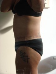 3 weeks post op side