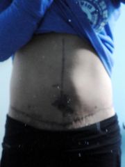 front - 3 months post body lift