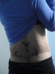 back- 3 months post body lift
