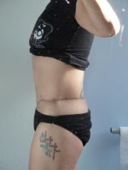 body lift scars, almost 1 year on
