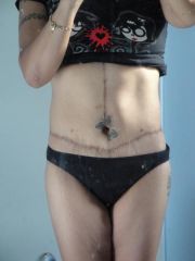 body lift scars, almost one year on