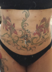 Weird grid-like bruising. Also have bruising on my sides and back but I can't get my camera to get good shots of those!