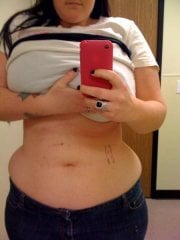 16 days post op and 30 lbs lost