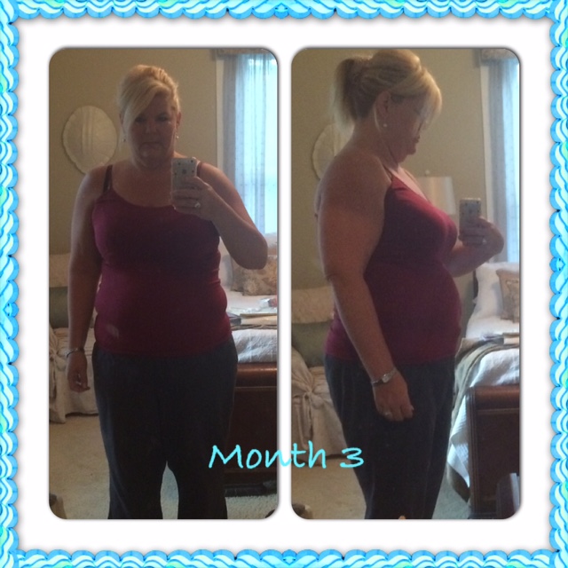 3 Months Postop -44lbs