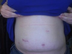 Post op scars- 6 weeks post op
the big one is my port