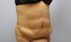 My Bariatric Life before weight loss and plastic surgeries