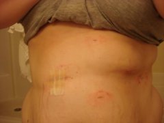 my battle wounds