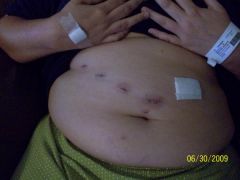 day after surg