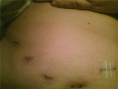 3week incisions