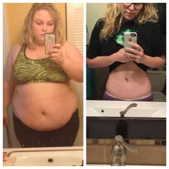 Excess skin, 173 lbs lost (no plastics)
