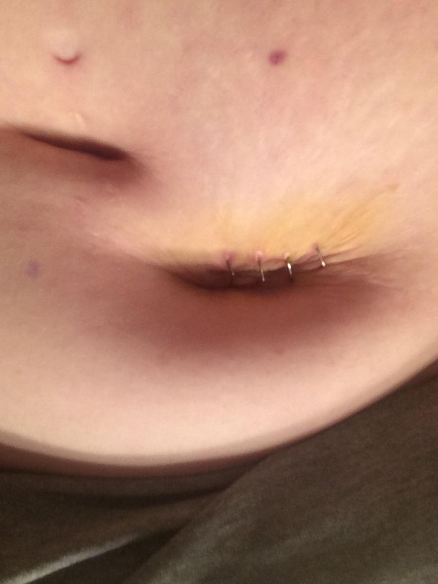 Post op