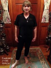 12 Weeks post Op Feb 7. 2015