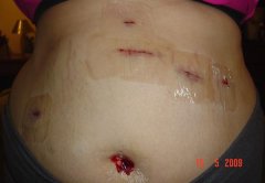 incisions
