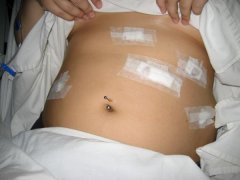 1 day post op