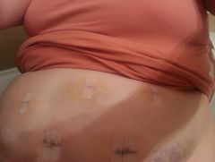 20131117 Stomach after surgery. 4 days out.