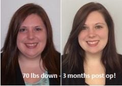 70lbs down 3 months post op!