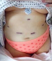Taken the day of surgery - 213.6
