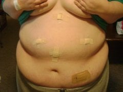 Incisions