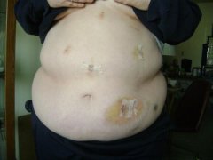 post op boo boo's
